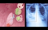 Virus RS và việc bảo vệ trẻ sinh non Virus RS và việc bảo vệ trẻ sinh non