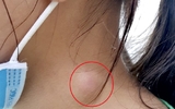Hóc xương cá – nên làm gì và không nên làm gì khi bị hóc xương trong họng Hóc xương cá – nên làm gì và không nên làm gì khi bị hóc xương trong họng